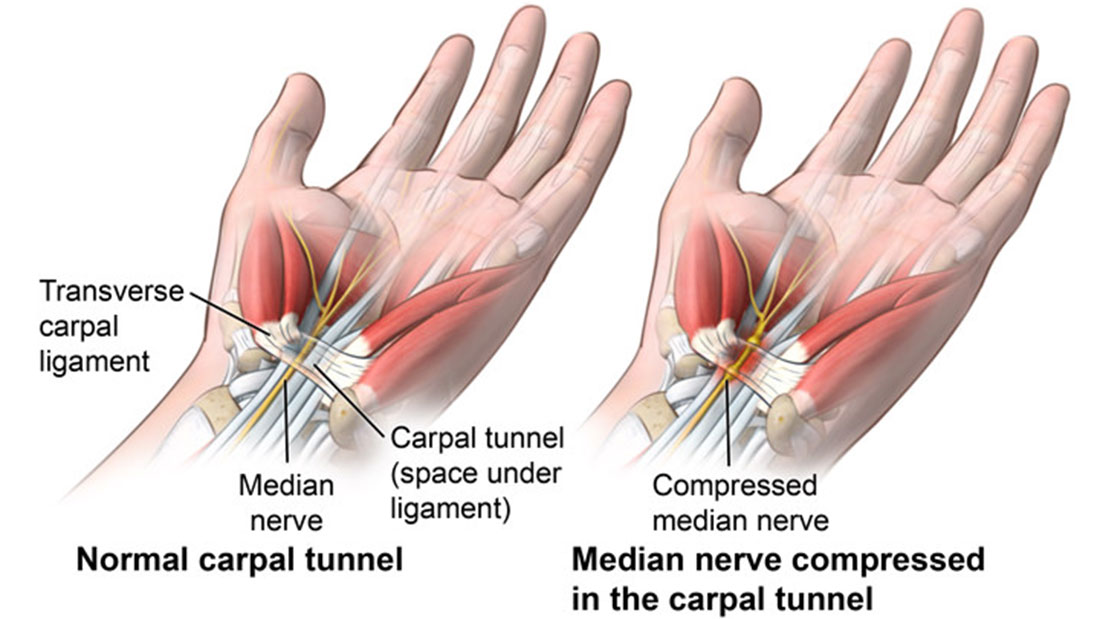 Carpal Tunnel Syndrome